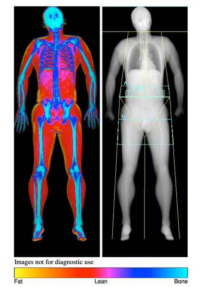 DEXA Body Scan with Consultation